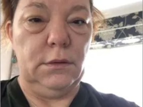 “我以为我只是累了，但我浮肿的眼睛是癌症的征兆。”